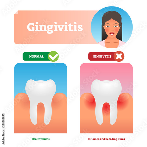 Gingivitis vector illustration. Medical oral mouth illness symptoms example