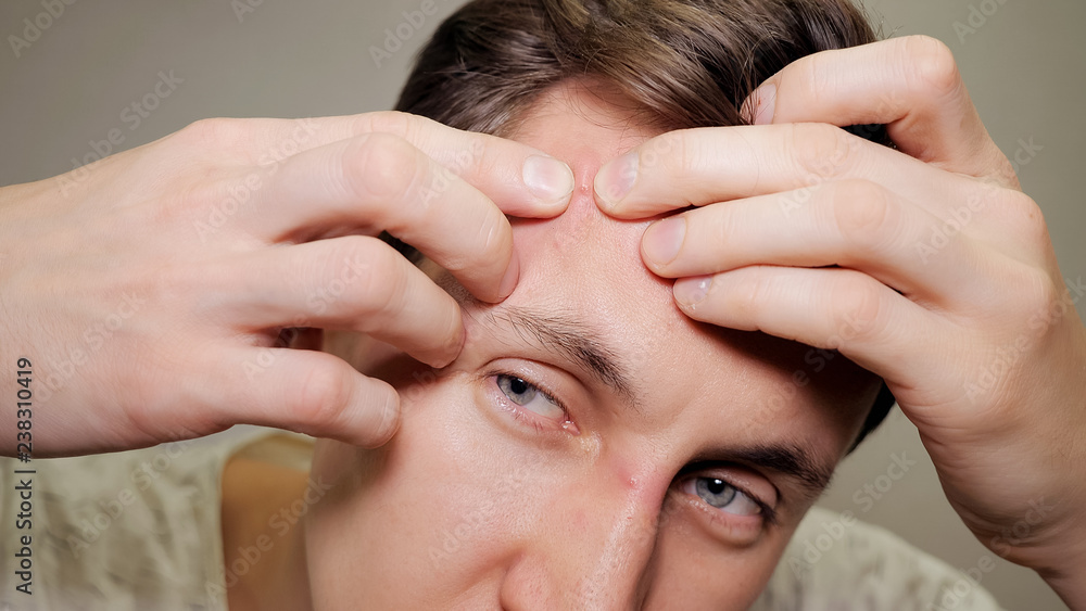 Fototapeta premium young man squeezing a pimple. Acne treatment.