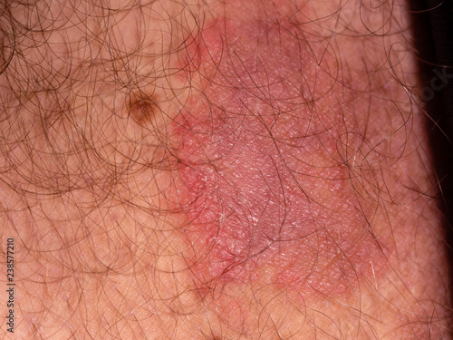 Fungal infection on skin of male leg