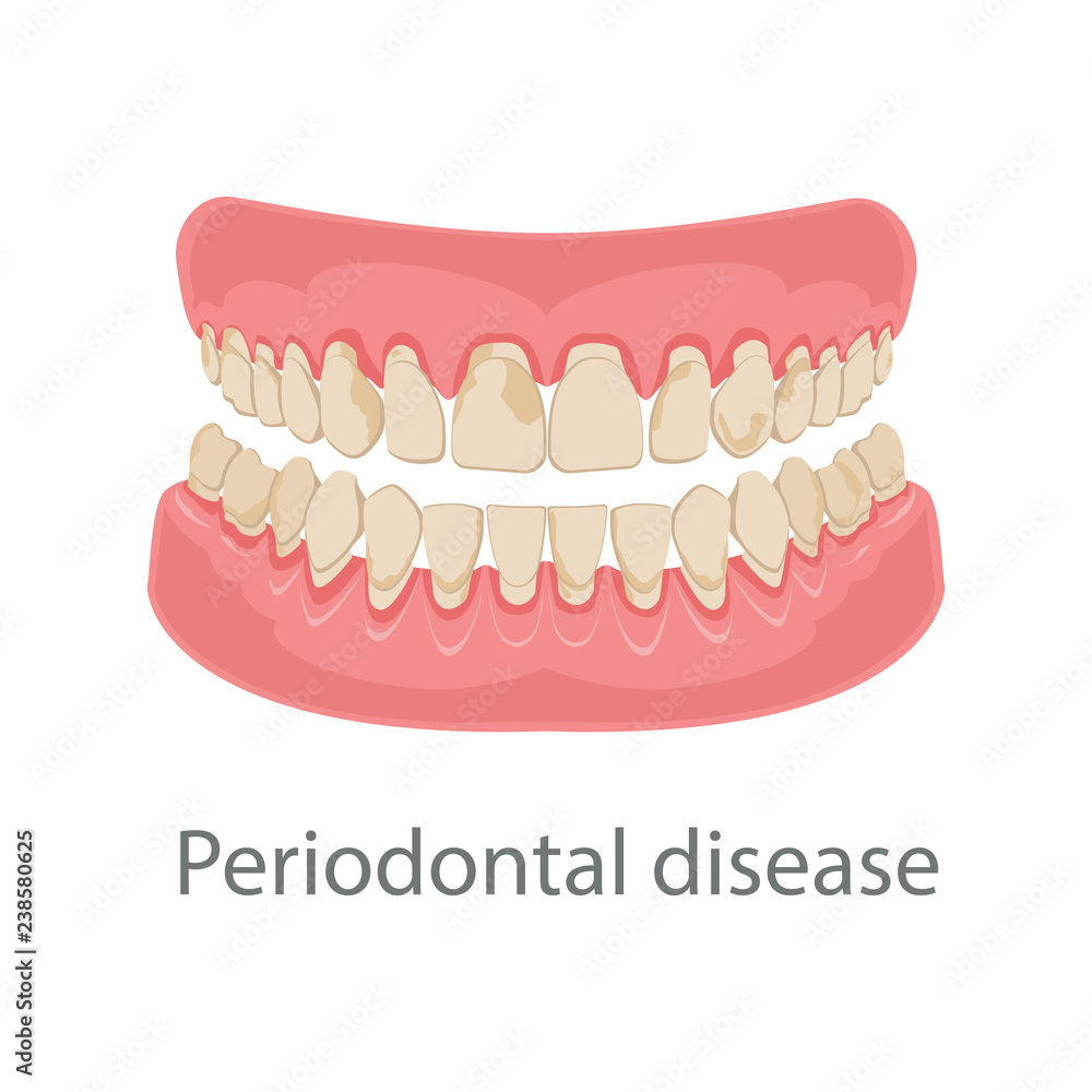 Obraz premium Dental concept, gum treatment. Gum disease and teeth, periodontal disease. Gum disease, bleeding gums, unhealthy teeth, yellow teeth, bad teeth. Vector illustration.