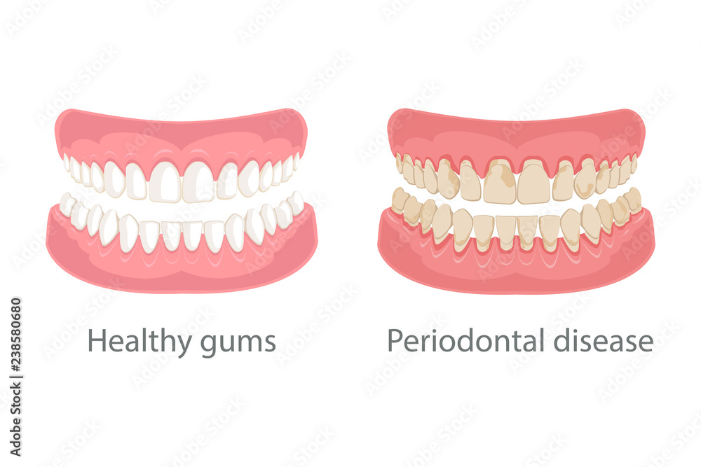 Dental concept, gum treatment. Gum disease and teeth, periodontal disease. Gum disease, bleeding gums, unhealthy teeth, yellow teeth, bad teeth. Vector illustration. Dental concept, gum treatment. Gum disease and teeth, periodontal disease. Gum disease, bleeding gums, unhealthy teeth, yellow teeth, bad teeth. Vector illustration.