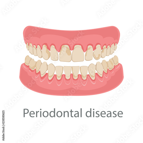 Dental concept, gum treatment. Gum disease and teeth, periodontal disease. Gum disease, bleeding gums, unhealthy teeth, yellow teeth, bad teeth. Vector illustration.