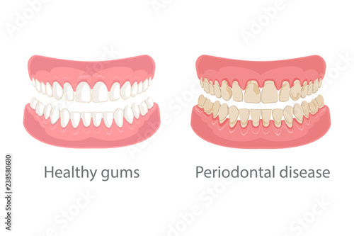 Dental concept, gum treatment. Gum disease and teeth, periodontal disease. Gum disease, bleeding gums, unhealthy teeth, yellow teeth, bad teeth. Vector illustration.
