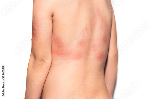 prickly heat on skin back children