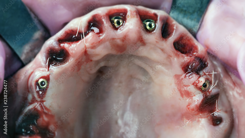 Obraz premium established multi units on implants for the subsequent installation of Dental prosthesis