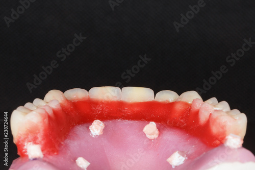 Dental prosthesis with the inside of the model