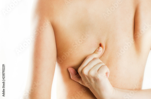 Birthmark on the female back, close-up