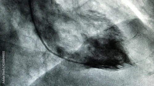 Catheterization. Cardiac ventriculography is a medical imaging test used to determine a patient cardiac function in the right or left ventricle