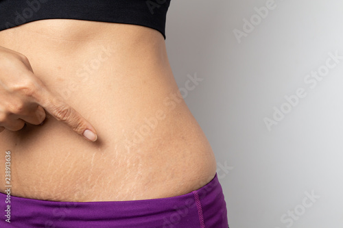 Foto Women Show off the belly after birth