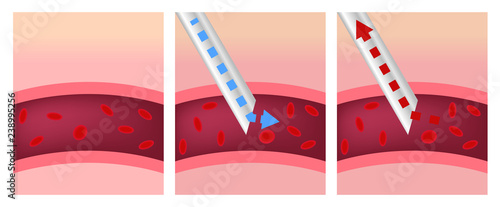 syringe sucking a blood out of blood vessel