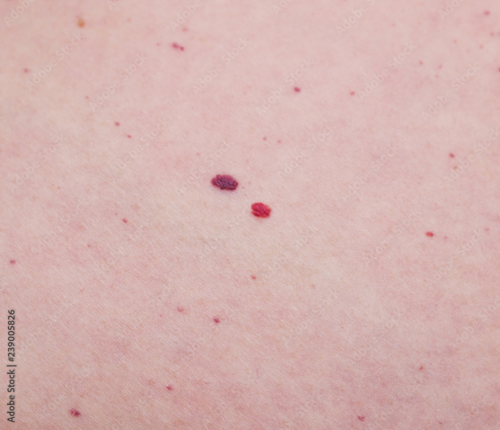 Hemangioma, microhematoma on human skin, closeup, disease Stock Photo