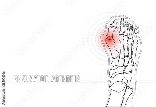 Rheumatoid arthritis continuous line drawing concept banner