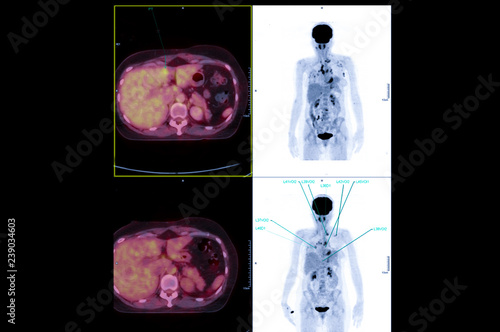 PET Scan image of whole body Comparision Axial , Coronal  plane in patient Liver cancer recurrence treatment by PET CT photo