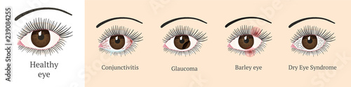 Most common eye problems. photo