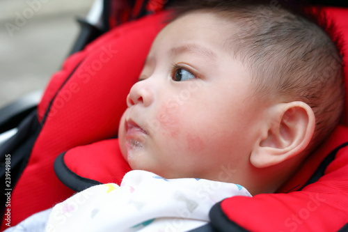 Foto cute baby boy playful bubbles saliva drool on child mouth with allergic rash on