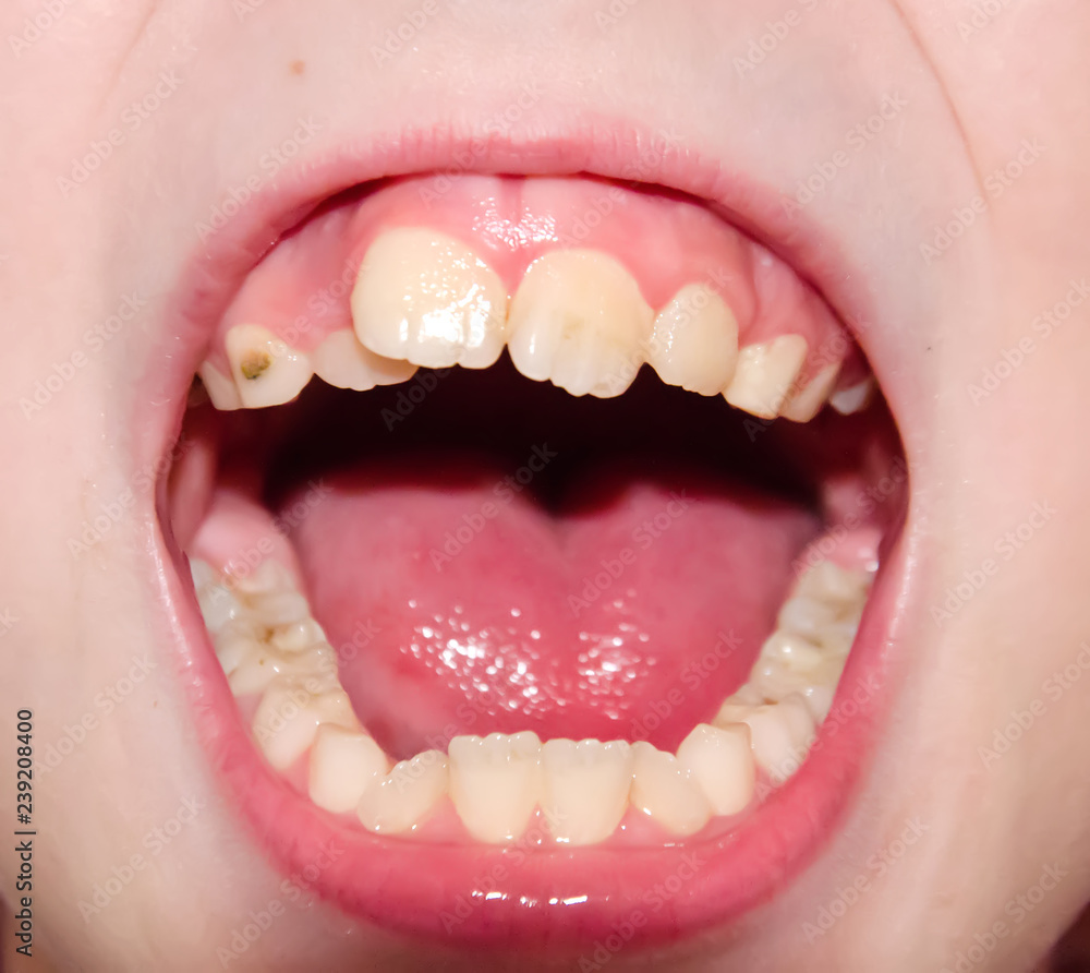 Fototapeta premium baby mouth, crooked teeth caries 