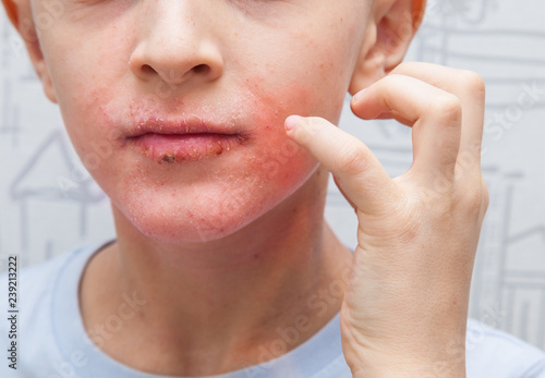Boy scratching his face. Human skin, presenting an allergic reaction, allergic rash on face and lips. photo