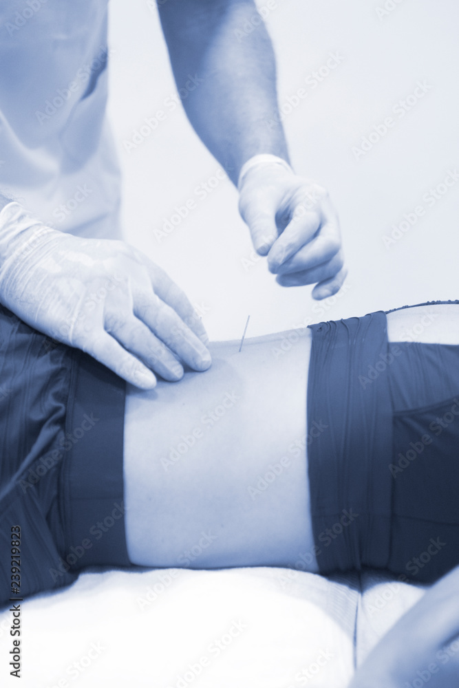 Fototapeta premium Dry needling EPI needle