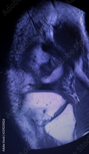 MRI knee meniscus tear scan photo