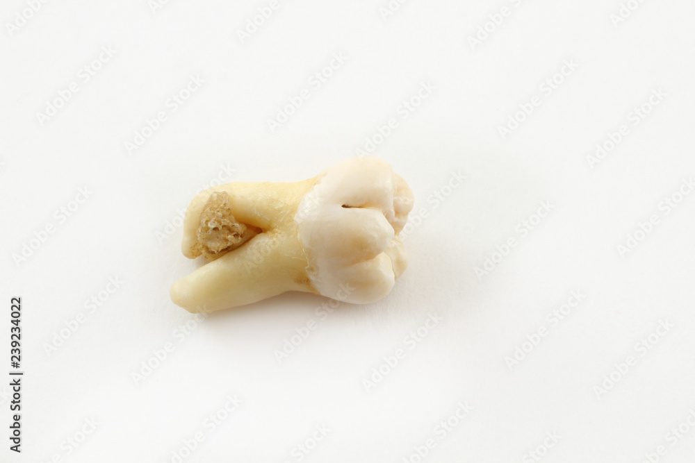 Eighth lower tooth removed together with a piece of bone tissue on paper. Wisdom tooth Eighth lower tooth removed together with a piece of bone tissue on paper. Wisdom tooth