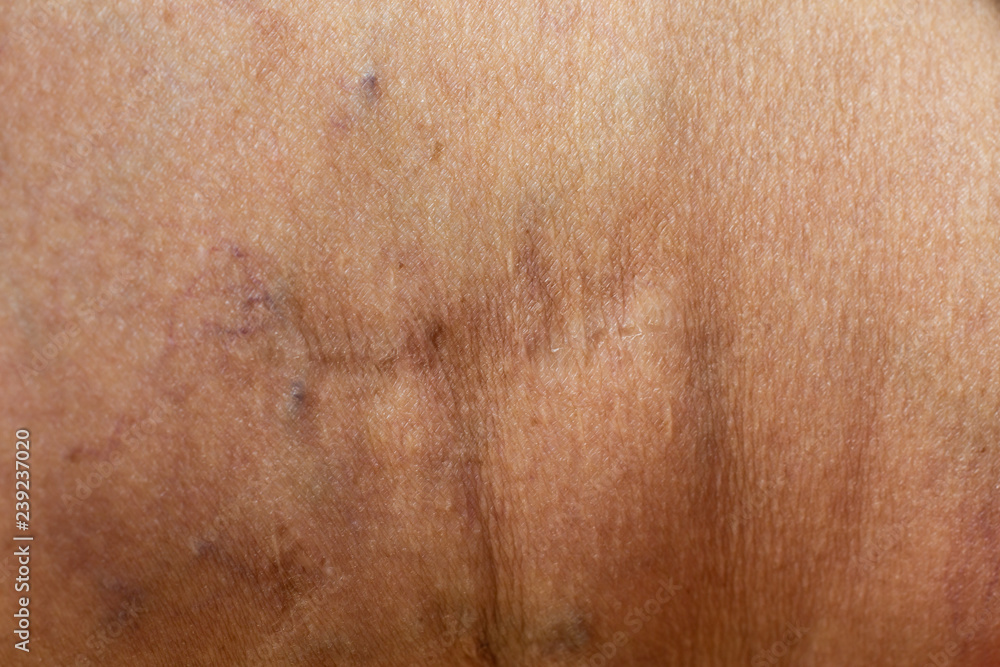 Naklejka premium Varicose veins on a leg in Senior women, Close up & Macro shot, Selective focus, Body concept