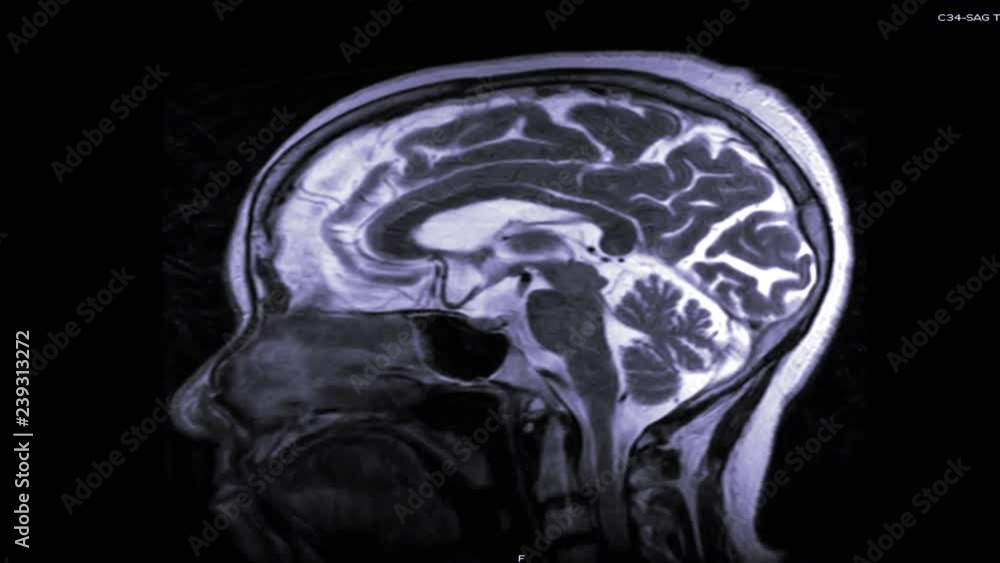 MRI of the brain in sagittal plane with contrast media. magnetic ...