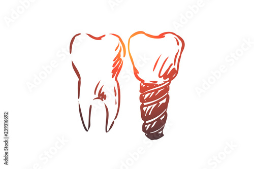 Implant, dental, tooth, health, care concept. Hand drawn isolated vector.