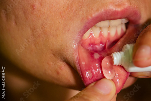 close - up on the lip with aphthous stomatitis applying antibacterial cream