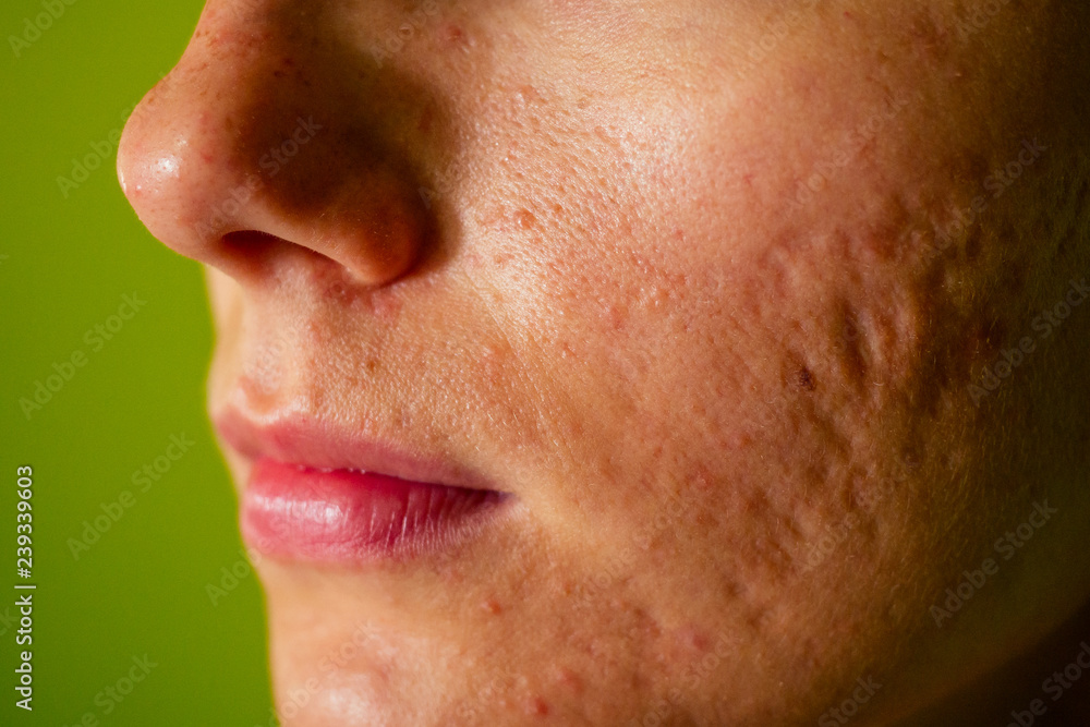 postacne, scars and red festering pimples on the face of a young woman