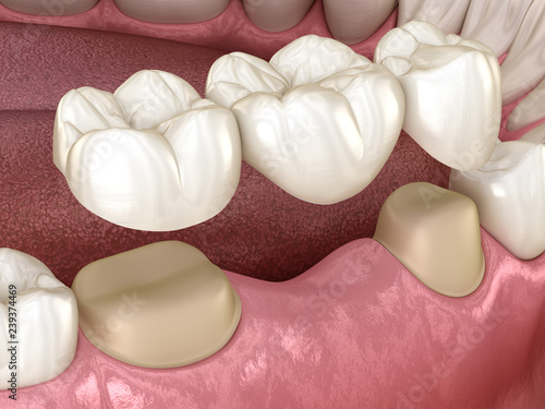 Fototapeta Naklejka Na Ścianę i Meble -  Dental bridge of 3 teeth over molar and premolar. Medically accurate 3D illustration of human teeth treatment