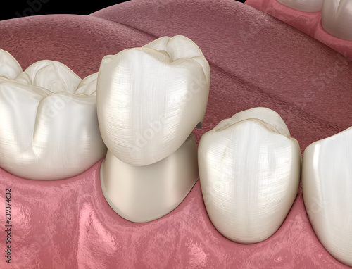 Proces montażu zęba przedtrzonowego korony dentystycznej. Medycznie dokładna ilustracja 3D leczenia ludzkich zębów