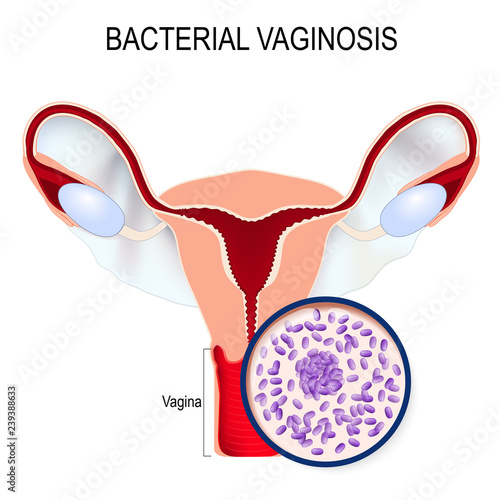 Uterus and close-up of Gardnerella vaginalis photo