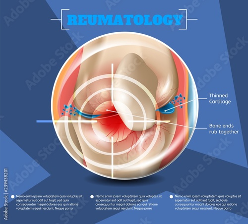 Realistic Illustration Reumatology Medicine in 3d photo