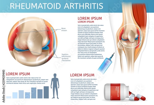 Infographic Treatment Method Rheumatoid Arthritis