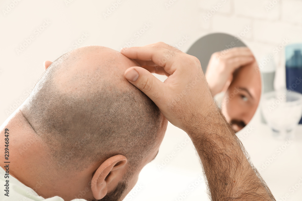 Obraz premium Man with hair loss problem looking in mirror