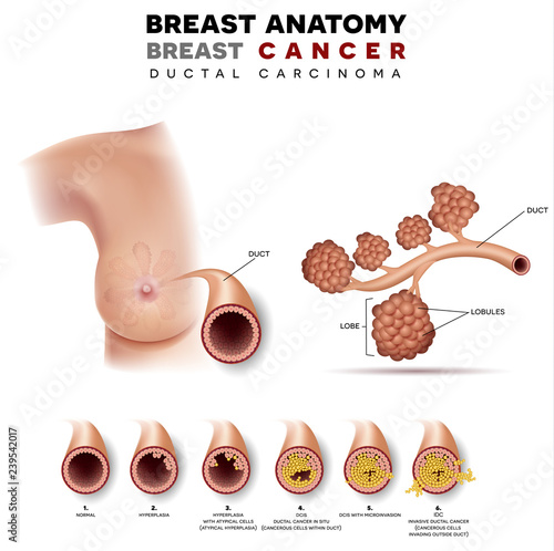 Breast cancer anatomy illustration, Ductal carcinoma of the breast, detailed medical illustration. Normal duct anatomy, Ductal cancer in situ and invasive ductal cancer 