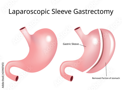 Laparoscopic Sleeve Gastrectomy (Vertical Gastrectomy)/ Weight loss surgery vector - Vector