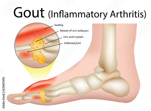 Gout (Inflammatory arthritis) Gout is an intensely painful type of arthritis , Illustration - Vector photo