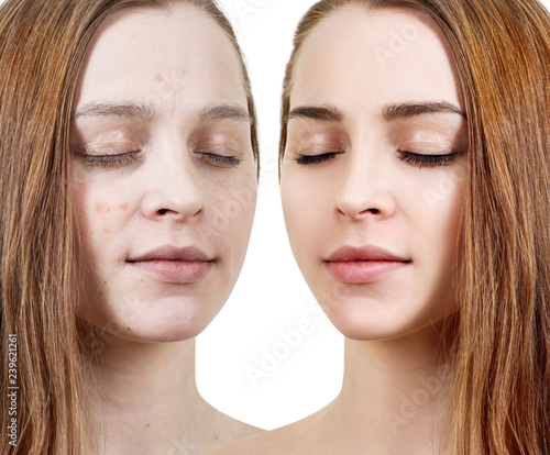 Young woman before and after skin treatment and makeup.