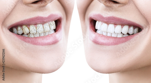 Teeth of young woman before and after treatment.