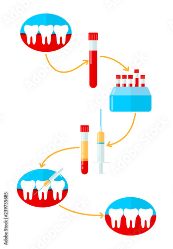 Infographics of making plasma for dentistry, bleeding gum, gingivitis. Vector illustration in flat style.