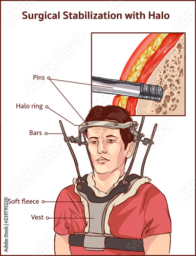 Vetor do Stock: Lateral view of adult male in Halo vest traction | Adobe  Stock