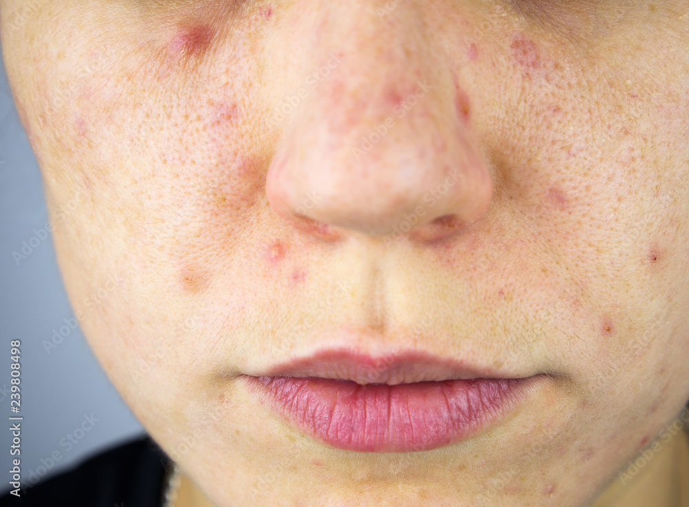 Young woman with acne, melasma, dark spots, freckles on his face. Dermatology, problem skin care and health concept image. Part of body, selective focus. Young woman with acne, melasma, dark spots, freckles on his face. Dermatology, problem skin care and health concept image. Part of body, selective focus.