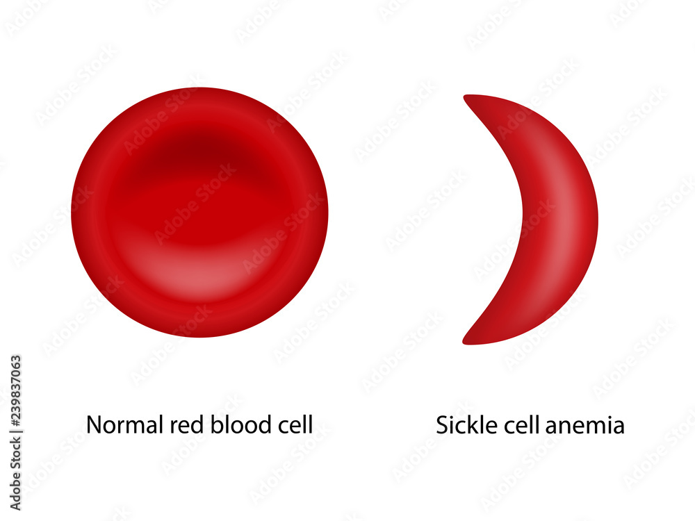 vegetation Maestro Rytmisk Illustration of Normal red blood cell and Sickle cell anemia Stock-vektor |  Adobe Stock