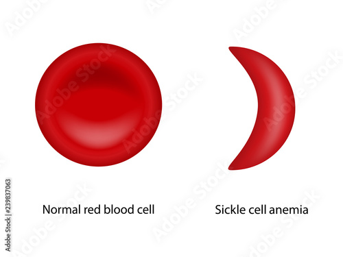 Illustration of Normal red blood cell and Sickle cell anemia