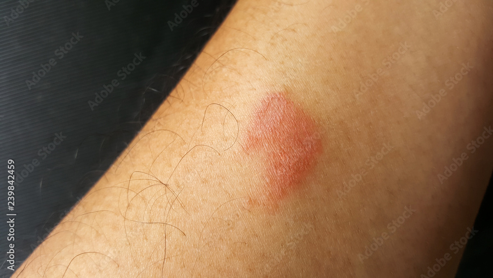 close-up centipede bite, poisonous hurt arm close-up centipede bite, poisonous hurt arm