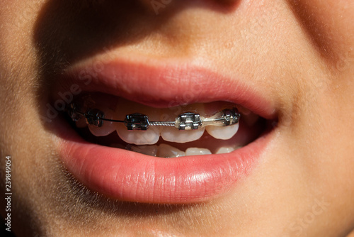 Fixed device with elastic on the teeth of a teenager