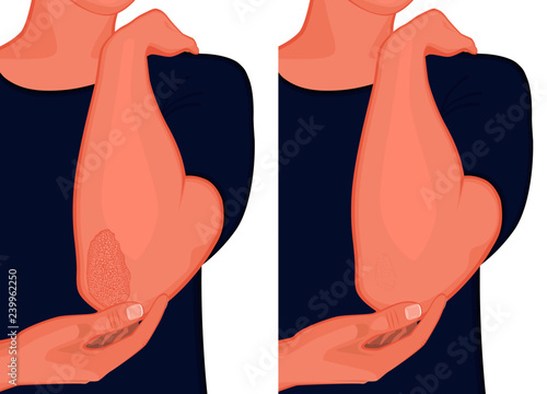 Vector illustration. Psoriasis on the elbow skin before and after treatment. For advertising and medical publications