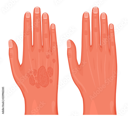 Vector illustration. Psoriasis on the skin of the hands before and after treatment. For advertising and medical publications