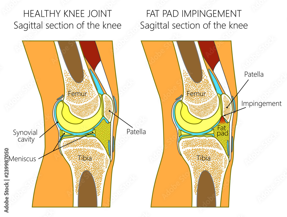 Vector Illustration Of A Healthy Human Knee Joint And Unhealthy Knee Vector Illustration Of A Healthy Human Knee Joint And Unhealthy Knee